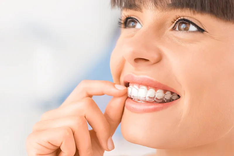 A clear orthodontic aligner being fitted over the upper teeth