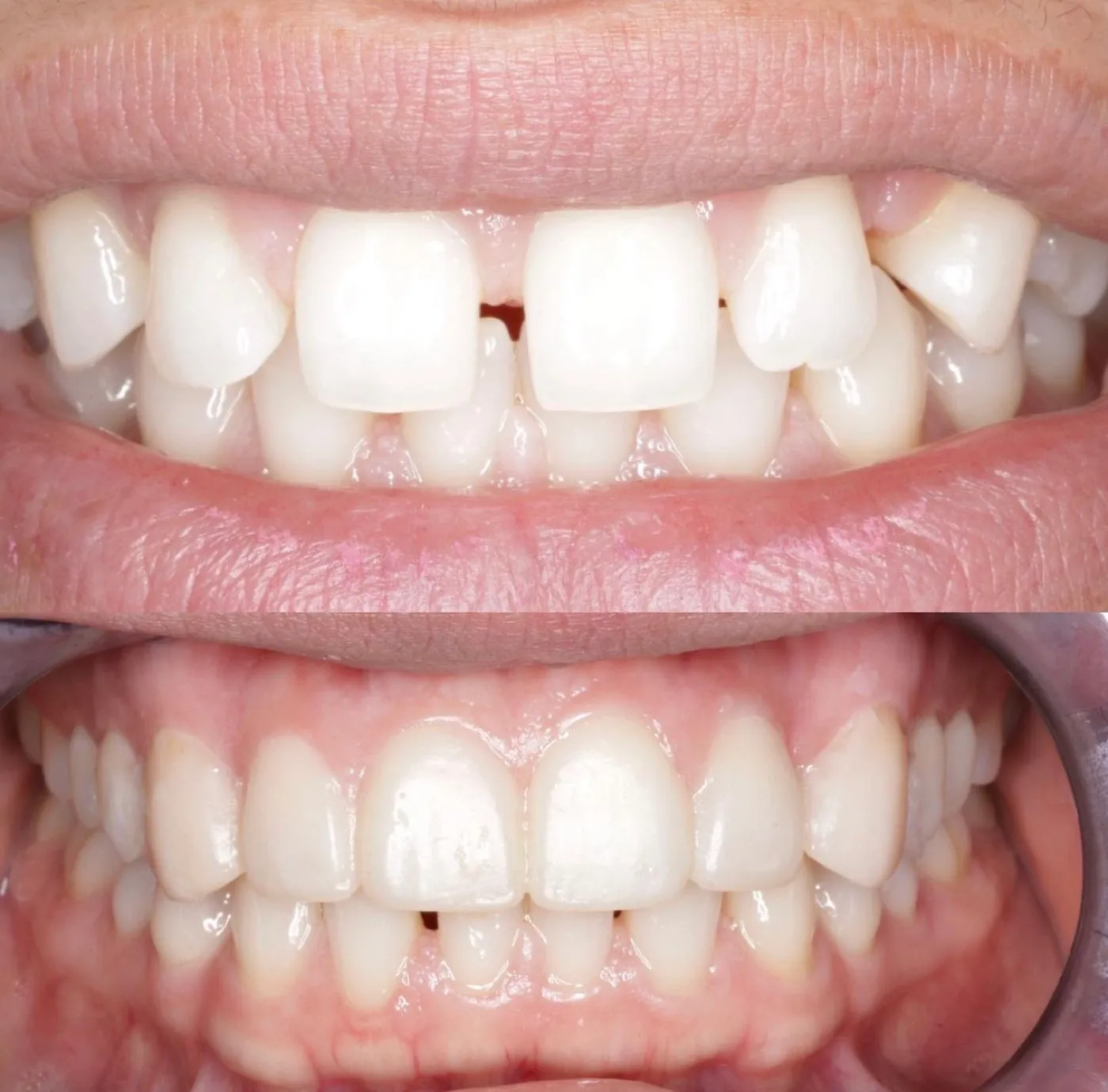 Before and after: a gap between the upper front teeth closed, shown stacked