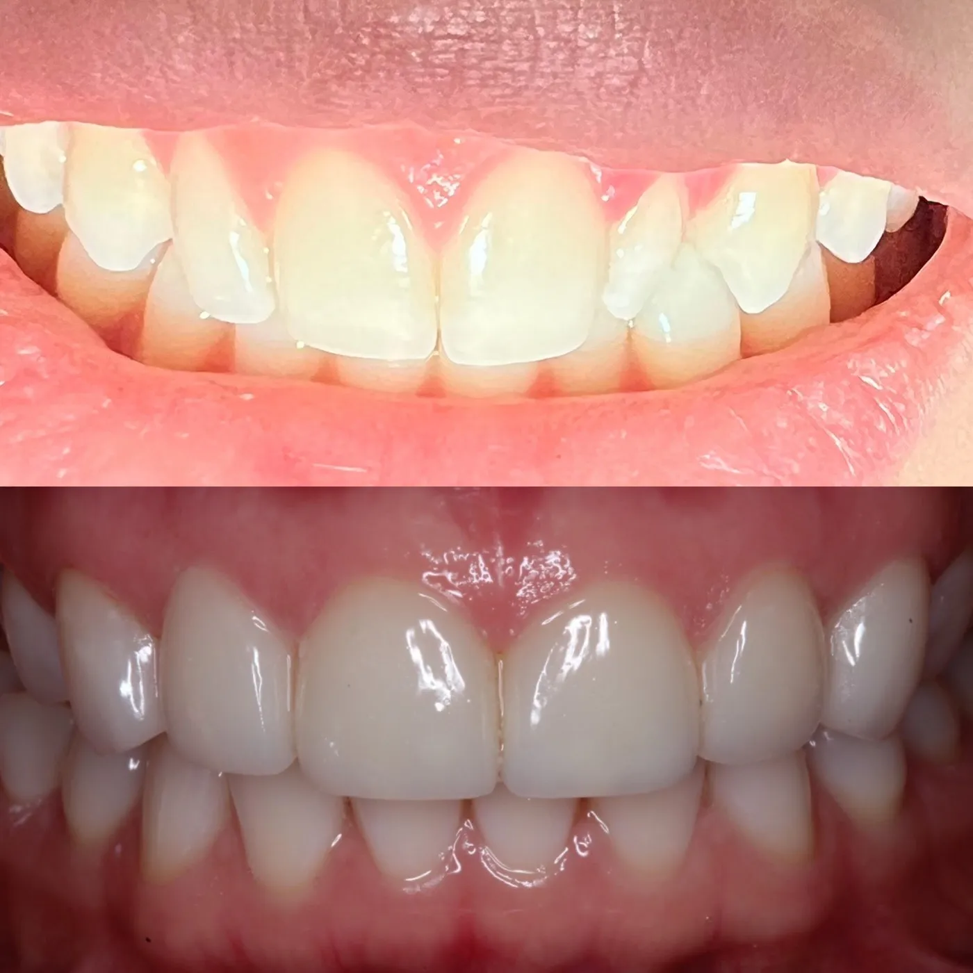 Before and after: worn, uneven upper incisal edges restored with porcelain, shown stacked
