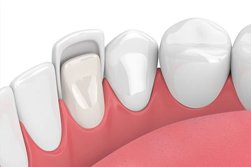 Close-up of porcelain veneers restoring the upper front teeth